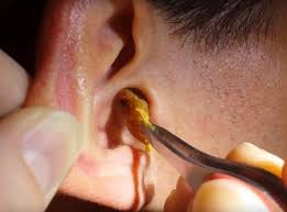 Ear Wax Microsuction (1 ears) - £45